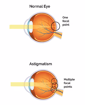 Diagram comparing a normal eye with one focal point and an astigmatism eye with multiple focal points