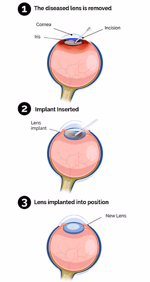 Infographic showing the three steps of cataract surgery: removal of the diseased lens, insertion of the implant, and implantation of the new lens.