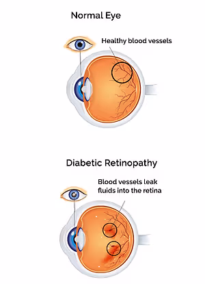 Normal eye shows healthy blood vessels, diabetic retinopathy shows blood vessels leaking fluids into the retina.