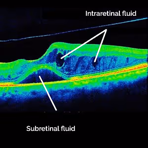 Optical coherence tomography image highlighting intraretinal and subretinal fluid accumulations.