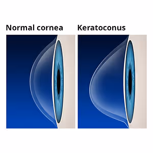 Comparison of a normal cornea and a cornea with keratoconus, showing the shape difference clearly.