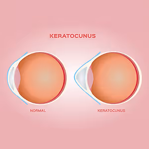 Diagram showing normal and keratoconus eye