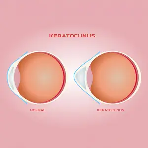 Diagram showing normal and keratoconus eye