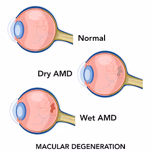 Illustration of normal, dry, and wet AMD in the eye, showing the progression from normal to advanced stages of macular degeneration.