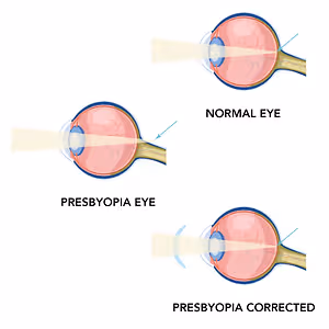 Illustration showing a normal eye, a presbyopia eye, and a presbyopia corrected eye