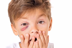 A young boy with a bruise on his left cheek poses for a photo