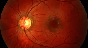 Fundus photograph showing a healthy retina with a bright yellow central region and branching blood vessels