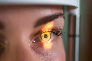 A woman's eye with a yellow tint in a room with a bright light.