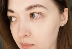 A woman with brown eyes and a red spot on her right eye