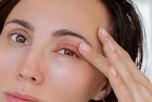 woman with a red eye and swollen eyelid
