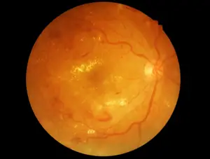 Fundus image showing detailed view of the retina with prominent blood vessels and a bright central reflex