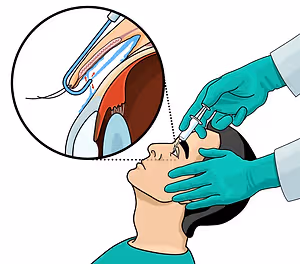 Illustration of an eye doctor performing a corneal injection with an enlarged cross-section of the eye showing the needle.