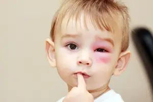 A young boy with a red rash on his face, looking directly at the camera with his finger on his lips