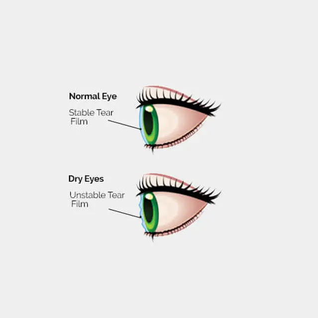 Illustration showing a normal eye with a stable tear film and a dry eye with an unstable tear film.