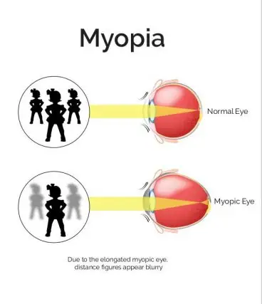 Image showing how myopia affects vision, comparing a normal eye and a myopic eye.