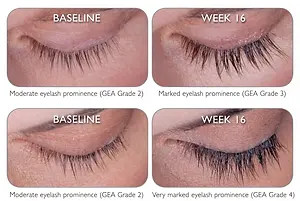 before and after image of eyelashes at baseline and week 16