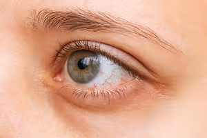 Close-up of a person's eye with a red blood vessel in the white part of the eye