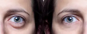 Close-up of two women's eyes with brown irises and red eyelids.