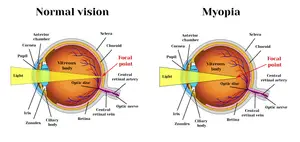 A diagram comparing normal vision and myopia in the human eye.