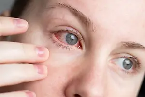 Close up of woman holding her eye and looking at the camera.