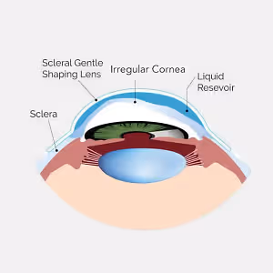 Diagram of the human eye showing the sclera, irregular cornea, liquid reservoir, and scleral gentle shaping lens.