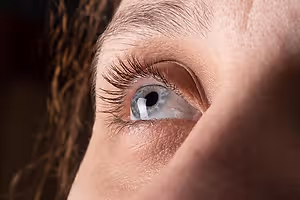 Close-up of a woman's eye with Kerotoconus