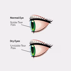 Illustration comparing a normal eye with stable tear film and a dry eye with unstable tear film.
