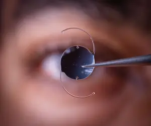 Close-up view of an eye with a contact lens being adjusted by a person