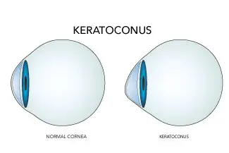 Illustration showing a normal cornea versus a cone-shaped cornea affected by Keratoconus.