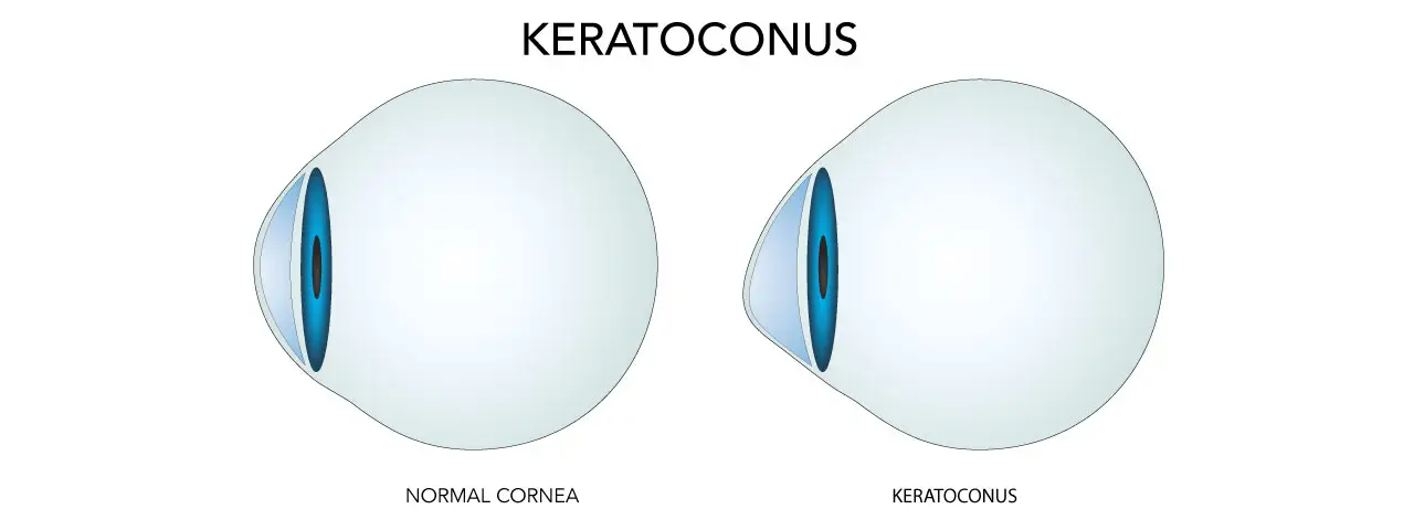 Illustration comparing a normal cornea to one affected by keratoconus