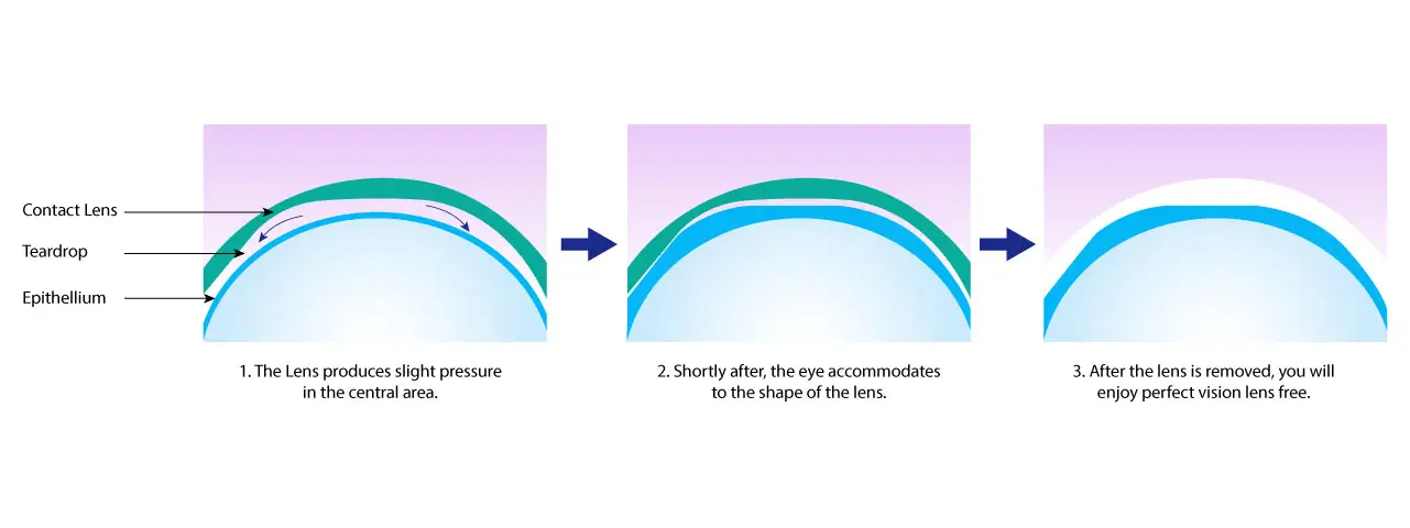 Infographic showing how a contact lens works on the eye, from slight pressure to perfect vision, then removal.
