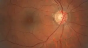 Fundus view showing central retinal artery occlusion with a pale retina and visible retinal vessels.