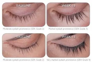 Comparison of eyelash prominence before and after treatment at week 16, showing moderate and marked grades.