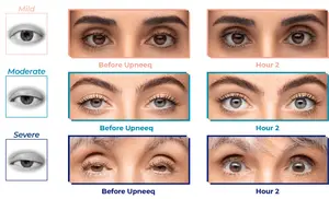 Images show the effect of Upneeq on the appearance of the eyes for mild, moderate, and severe cases, before and after two hours.