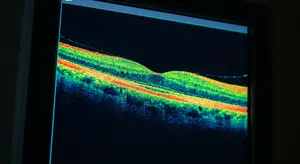 Optical Coherence Tomography image showing cross-sectional view of eye layers with highlighted areas