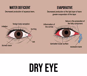 Infographic showing the causes and symptoms of dry eye, divided into two sections: water deficient and evaporative.