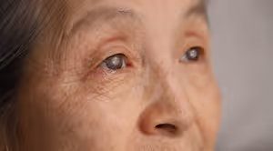 A close-up of an elderly woman's eyes with a grayish tint and wrinkles around them.