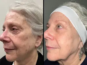 Before and after images of an older woman's face showing skin rejuvenation