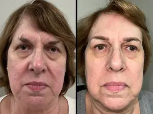 before and after photos of a woman with sagging skin on her face