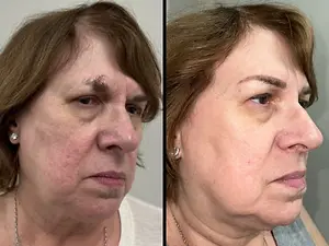 before and after photo of a woman's face showing improvement in skin texture and appearance