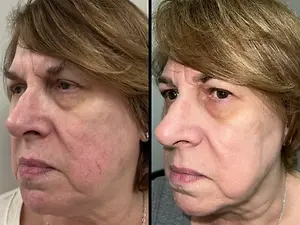 A before and after image of a woman's face showing skin rejuvenation after microneedling