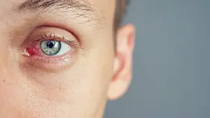 Close-up of a person with a red, irritated left eye