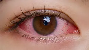 Close-up of a brown eye with visible redness and irritation