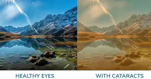 comparison between healthy eyes and eyes with cataracts