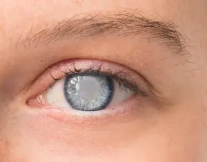 A close-up of a person's eye with gray iris and white pupil