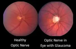 Comparison of a healthy optic nerve and one affected by glaucoma, both images show the optic nerve in a red, circular background with blood vessels.