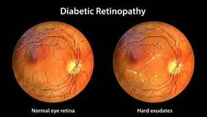 Diagram showing a normal eye retina compared to one with hard exudates due to diabetic retinopathy