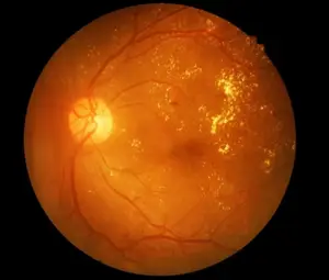 a close up of a human retina showing orange color with blood vessels