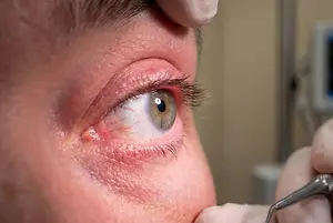 Close up of a person's eye with a tool nearby, possibly for an eye examination or surgery.