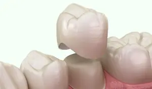 Illustration of a dental crown fitting over a tooth.